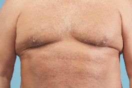 Liposuction in banashankari bangalore